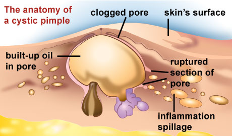 How to make acne go away fast